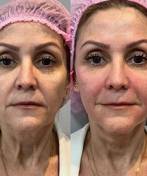 Rejuvenescimento facial antes e depois