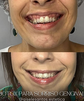 Botox sorriso gengival antes e depois