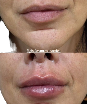 Preenchimento labial antes e depois